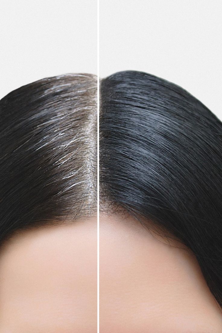 Premature Greying Treatment